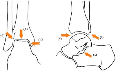 The ankle in XLH: Reduced motion, power and quality of life